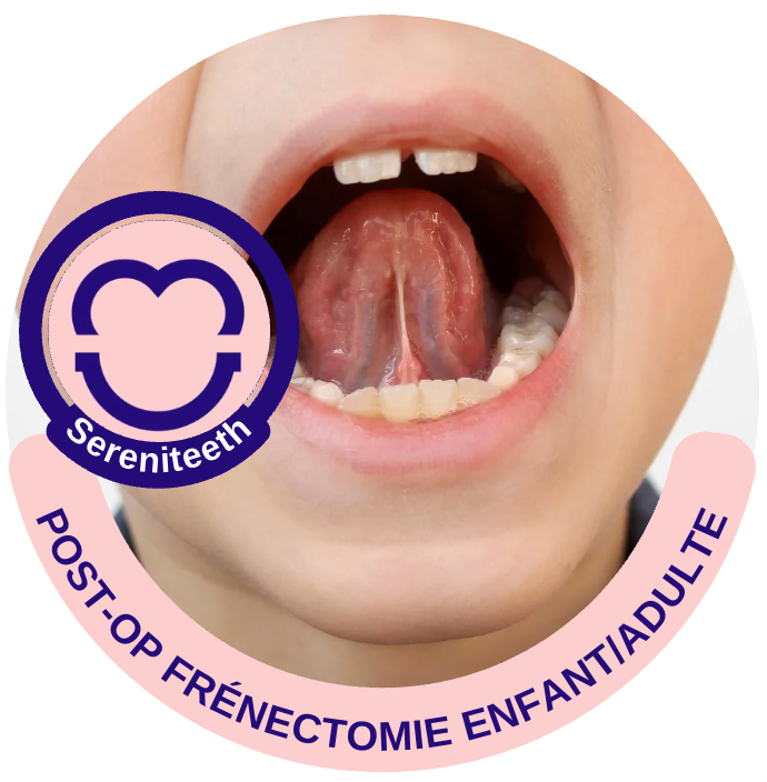Frénectomie linguale : post-op enfant/adulte avec Sereniteeth