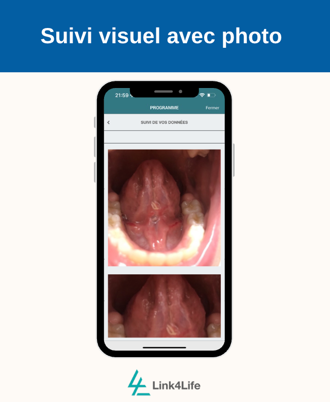 Frénectomie linguale : post-op enfant/adulte avec Sereniteeth