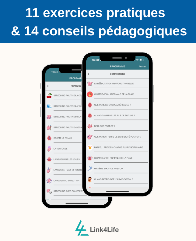 Frénectomie linguale : post-op enfant/adulte avec Sereniteeth