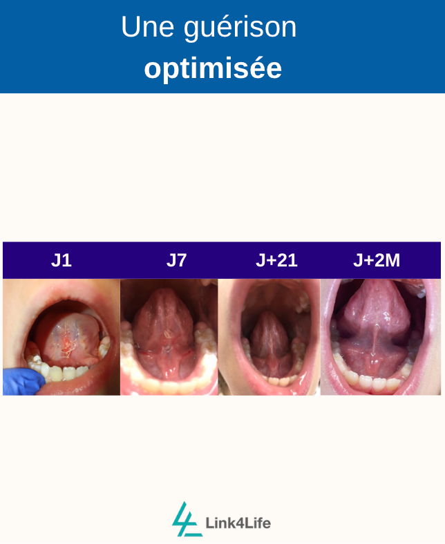 Frénectomie linguale : post-op enfant/adulte avec Sereniteeth
